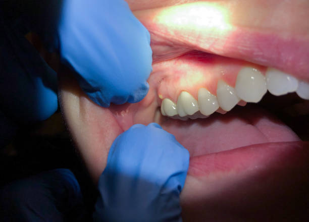 Best Chipped Tooth Repair Near Me  in Tremont, PA